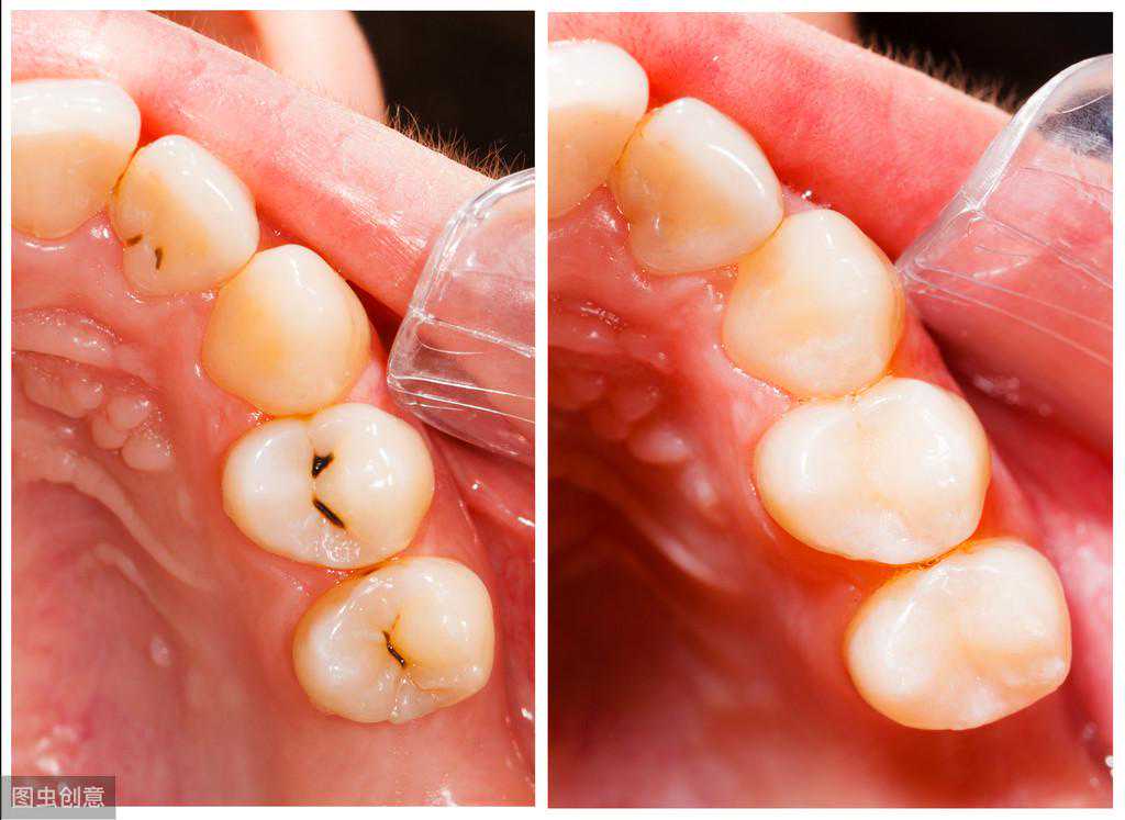 真相大白｜关于口腔龋齿的来龙去脉，值得收藏